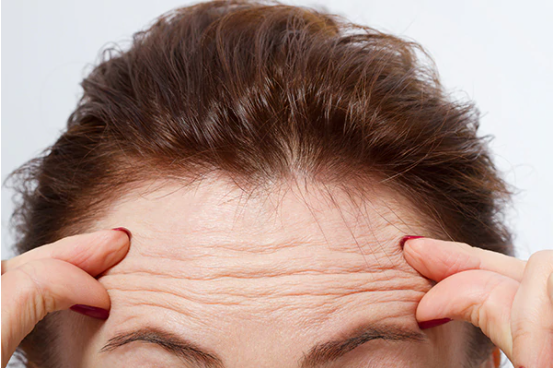 Say bye bye to Forehead Wrinkles once and for all